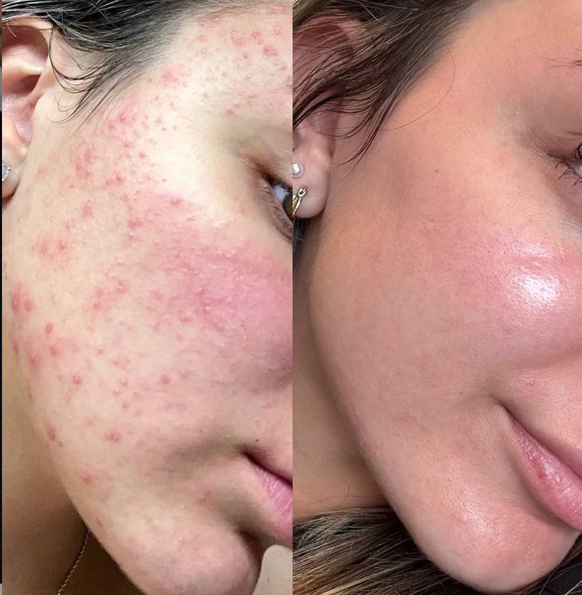 Acne and redness treatment results